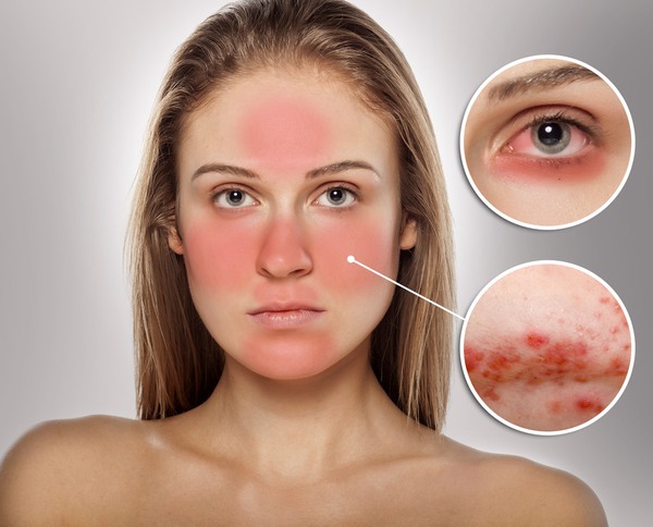 Rosacea_diagram-aea7b