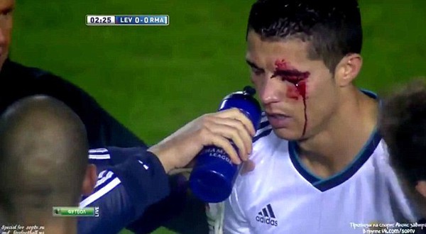 Mắt Ronaldo có vấn đề sau chấn thương kinh hoàng 1