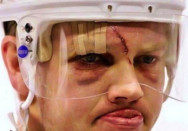 Những chấn thương rợn người trong môn hockey 15