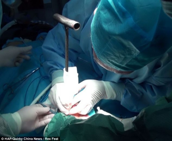 Người đ&agrave;n &ocirc;ng bị que kim loại chọc v&agrave;o mắt 5cm 2