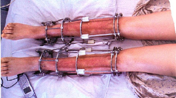 Phẫu thuật kéo dài chân như thế nào ảnh hưởng đến hình dáng cơ thể?
