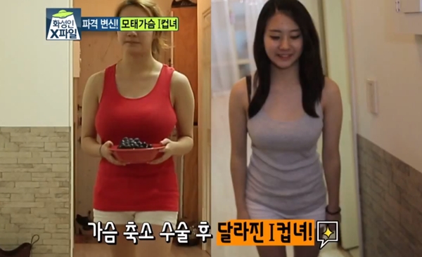 Hàn Quốc: Cô gái có "bộ ngực 2 cân" phẫu thuật lần 2 1