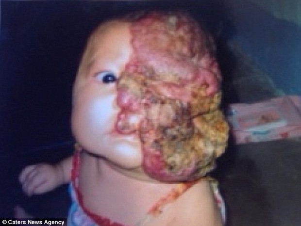 Bé gái 5 tuổi mang khối u che hết nửa gương mặt bất ngờ được một người xa lạ cứu sống - Ảnh 1.