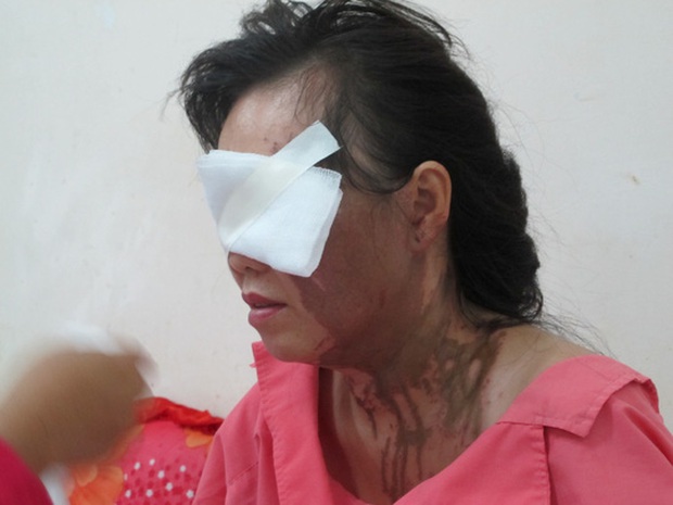 Một phụ nữ bị tạt axit tại trung tâm TP HCM - Ảnh 1.