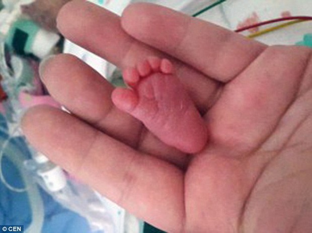 Kỳ tích sống sót của bé sơ sinh nhỏ nhất thế giới, nặng 220g với kích thước chỉ bằng 2 bàn tay - Ảnh 1.
