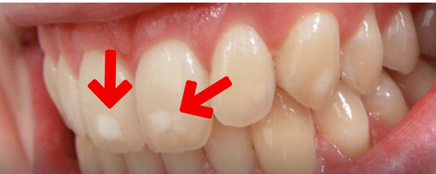 Răng bạn có những đốm trắng này không - hãy cẩn thận nếu thấy chúng - Ảnh 1.