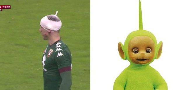 Kinh hoàng cảnh thủ môn Joe Hart đổ máu vì bị đạp vào đầu - Ảnh 4.