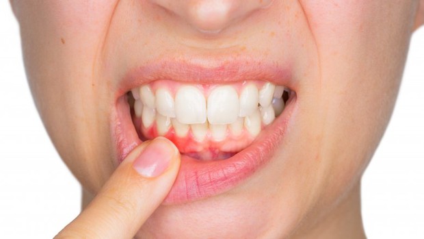 Bạn sẽ không dám lười đánh răng thêm lần nào nữa nếu biết tác hại kinh người sau - Ảnh 4.