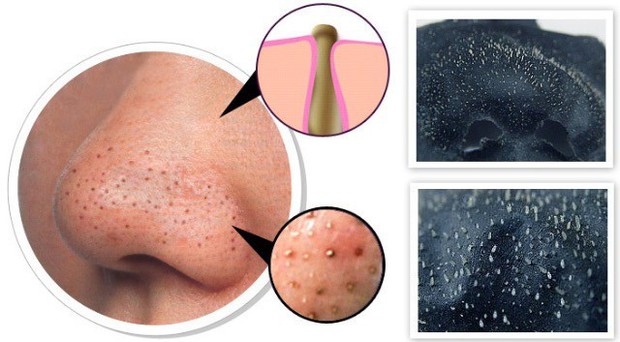 7 ngộ nhận sai lầm về mụn mà tới 90% người vẫn đang lầm tưởng - Ảnh 4.