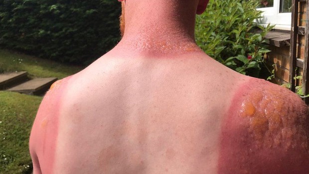 Nắng nóng kinh hoàng, chàng trai bị bỏng rộp nghiêm trọng khi làm việc ngoài trời suốt 7 tiếng - Ảnh 2.