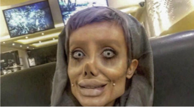 Girl had plastic surgery more than 50 times to look like Angelina Jolie, the result returned to Dobby the house elf - Photo 2.