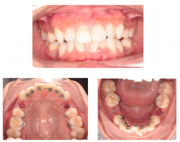 Chuyên gia cảnh báo: Đừng đợi quá muộn mới đi niềng răng - Ảnh 6.