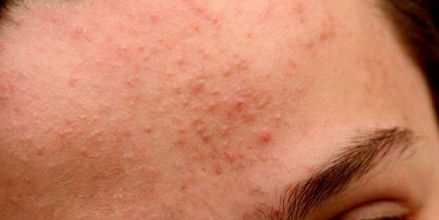 Lý do khiến mụn ẩn ồ ạt kéo đến và cách xử lý đơn giản nhất - Ảnh 1.