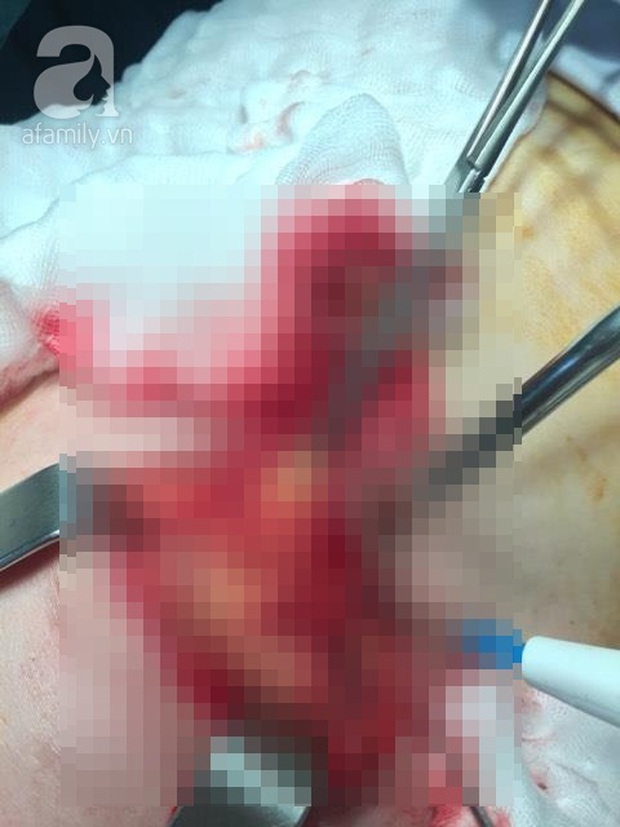 TP.HCM: Bơm silicon chui, một phụ nữ phải cắt bỏ toàn bộ ngực - Ảnh 1.