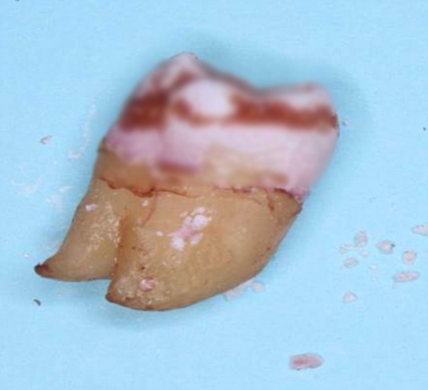 Một nha sĩ đã ngâm chiếc răng khôn của mình vào nước ngọt trong 2 tuần và nhận kết quả giật mình - Ảnh 2.