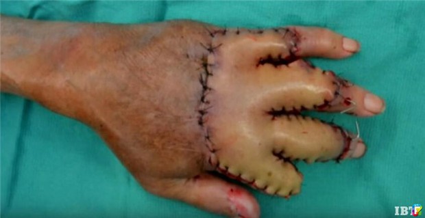 Bác sĩ khâu bàn tay bị bỏng nặng của cụ ông 87 tuổi vào bụng, chỉ 3 tuần sau, kỳ tích đã xảy ra - Ảnh 3.