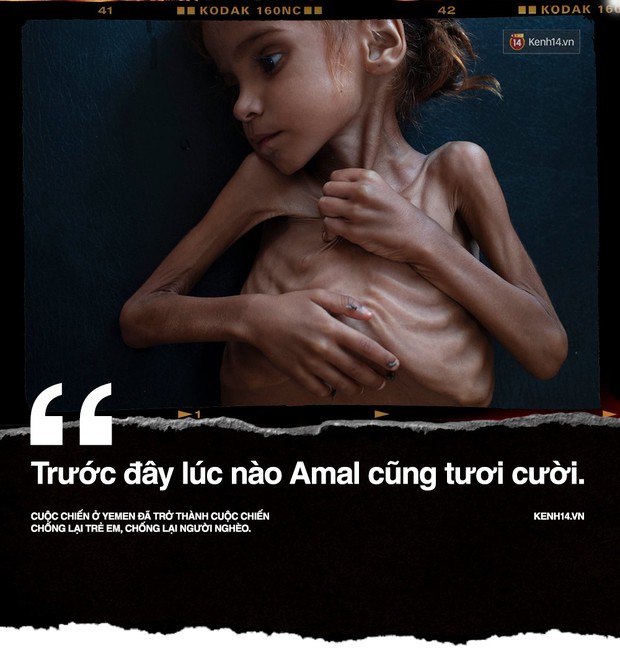 Amal Hussain: Biểu tượng nạn đói Yemen và sứ mệnh hy sinh cho cả dân tộc trên vai những đứa trẻ - Ảnh 1.