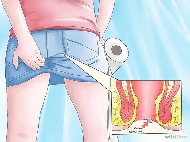 Có thể bạn đã mắc bệnh ung thư trực tràng nếu gặp phải một trong 5 triệu chứng bất thường sau - Ảnh 3.