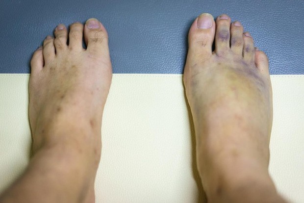 Chân bị bầm tím có thể do những bệnh đáng sợ gây ra vì vậy bạn cần thận trọng - Ảnh 1.
