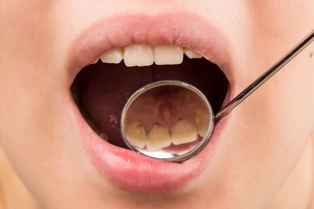 Hiện tượng buồn nôn khi đánh răng đang cảnh báo những căn bệnh gì trong cơ thể bạn? - Ảnh 3.