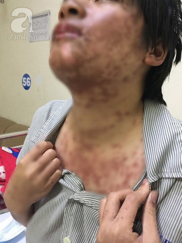 Cô gái 27 tuổi ở Bình Dương biến dạng mặt vì tự tiện mua thuốc trị sốt ngoài tiệm uống - Ảnh 1.