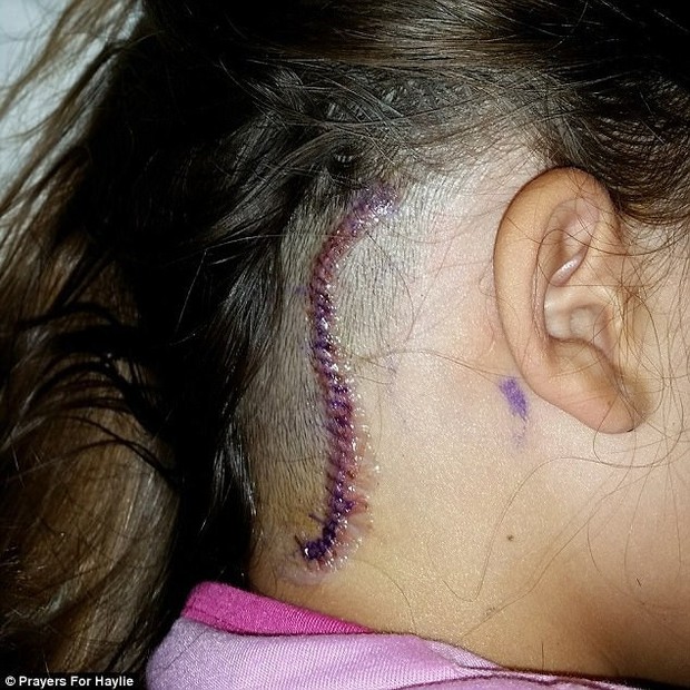 Tưởng là đau đầu thông thường, cô gái 14 tuổi được chẩn đoán có một khối u trong não - Ảnh 3.