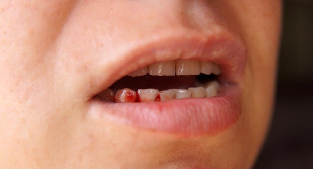 Chảy máu khi đánh răng: dấu hiệu sức khỏe bạn không nên coi thường - Ảnh 1.