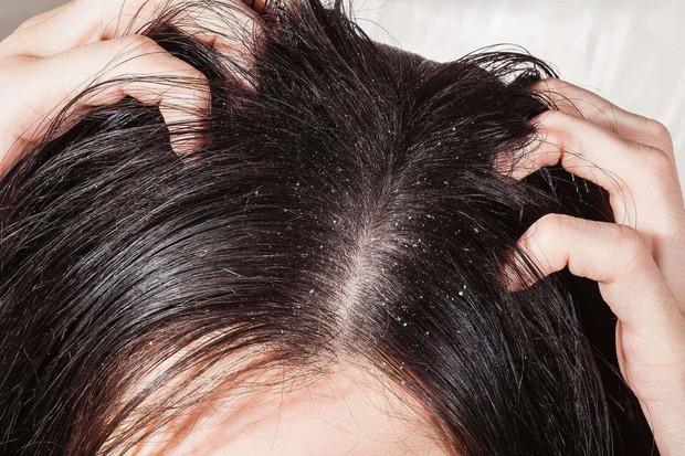Da đầu ngứa ngáy khó chịu có thể là dấu hiệu của những căn bệnh nguy hiểm sau - Ảnh 2.