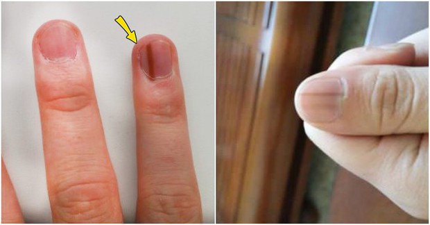 7 dấu hiệu cảnh báo bệnh nguy hiểm biểu hiện trên bàn tay của bạn - Ảnh 4.
