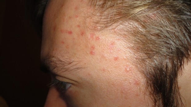 Bất kỳ vị trí mụn nào trên khuôn mặt cũng có thể cảnh báo tình trạng sức khỏe của bạn - Ảnh 4.