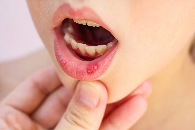 Một số vấn đề sức khỏe răng miệng không phải ai cũng biết - Ảnh 3.