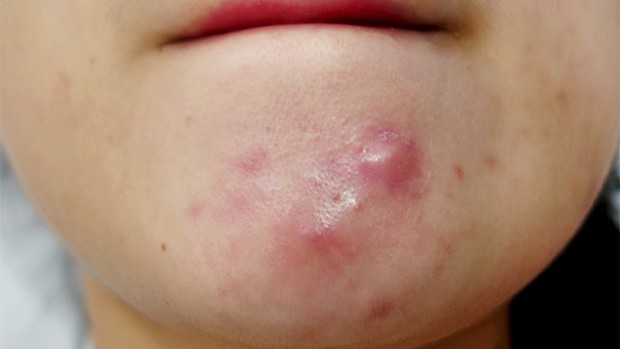 Mọc mụn ở bất kỳ vị trí nào trên khuôn mặt cũng có thể ngầm cảnh báo một vài vấn đề sức khỏe đang xảy ra trong cơ thể bạn - Ảnh 3.