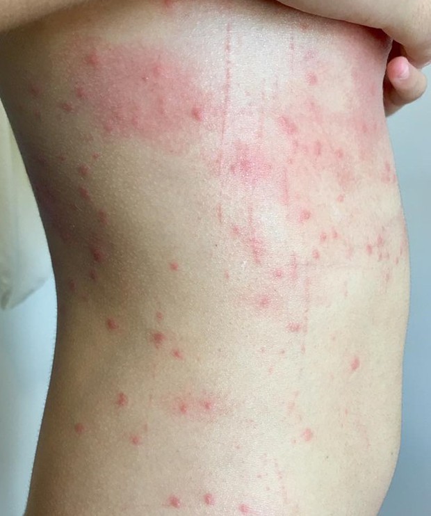 Xét nghiệm mẫu nước để tìm nguyên nhân nhiều du khách bị ngứa khi tắm biển Đà Nẵng - Ảnh 2.