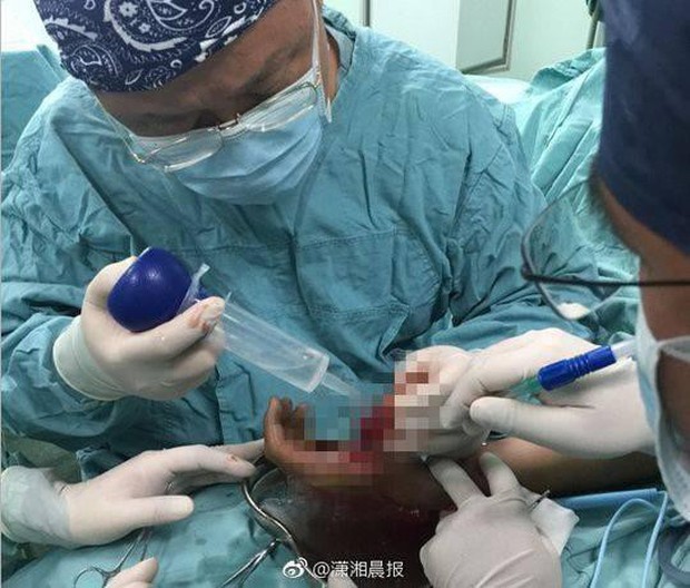 Trung Quốc: Nhặt chai Coca lạnh vừa đánh rơi xuống đất, thanh niên bị nổ gãy xương tay - Ảnh 3.