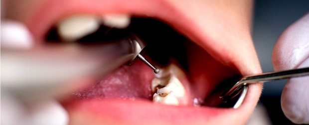 Nghiên cứu mới này sẽ khiến bạn không bao giờ dám quên đánh răng nữa - Ảnh 1.