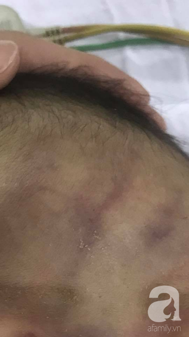 TP.HCM: Cha không giữ được bình tĩnh, “lỡ tay” làm con trai 2 tháng tuổi xuất huyết não vì quấy khóc không chịu ngủ - Ảnh 2. TP.HCM: Cha không giữ được bình tĩnh, “lỡ tay” làm con trai 2 tháng tuổi xuất huyết não vì quấy khóc không chịu ngủ - Ảnh 2.