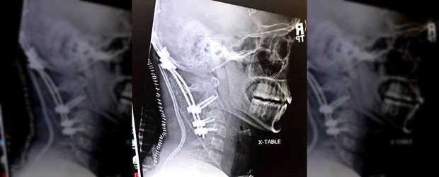 Chàng trai 22 tuổi gây chấn động y học vì sống sót sau tai nạn suýt rụng đầu - Ảnh 1.