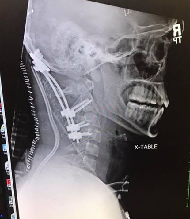 Chàng trai 22 tuổi gây chấn động y học vì sống sót sau tai nạn suýt rụng đầu - Ảnh 3.