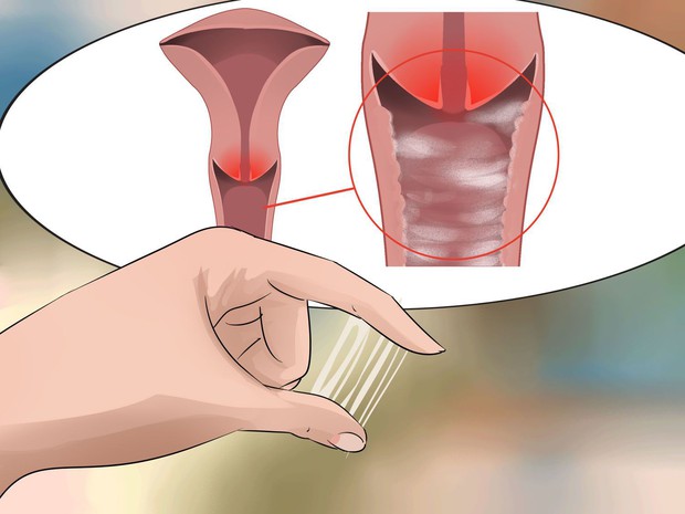 Vùng kín có mùi khó ngửi đang ngầm cảnh báo một số vấn đề sức khỏe mà bạn có nguy cơ gặp phải - Ảnh 5.