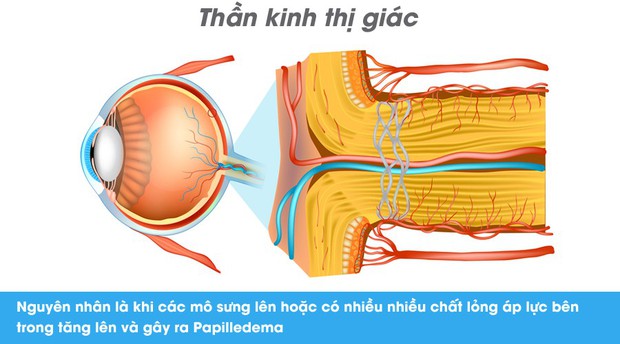 Thói quen kén ăn, chế độ ăn uống nghèo nàn có thể dẫn đến suy giảm thị lực nghiêm trọng cả hai mắt - Ảnh 3.