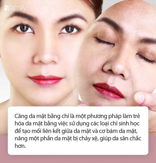 Trong các phương pháp căng da mặt, căng da mặt bằng chỉ, dù nhẹ nhàng nhất nhưng cũng có rủi ro biến chứng đi kèm! - Ảnh 2.