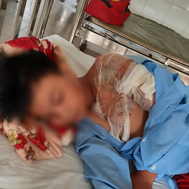 Xác minh thông tin bé trai ở Long An bị cha đẻ bạo hành, đổ nước sôi khiến bỏng nặng phải nhập viện - Ảnh 2.