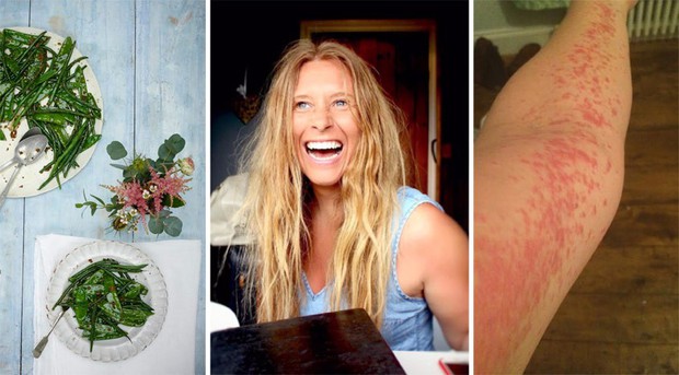 Thử chế độ ăn thuần chay trong 17 ngày: người phụ nữ ở Anh chữa khỏi bệnh vảy nến, tự tin mặc đẹp hơn - Ảnh 3.