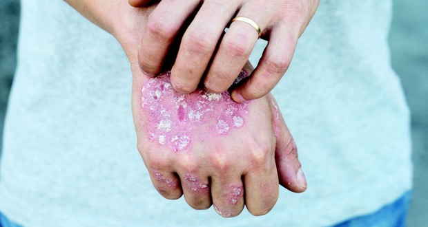 Thử chế độ ăn thuần chay trong 17 ngày: người phụ nữ ở Anh chữa khỏi bệnh vảy nến, tự tin mặc đẹp hơn - Ảnh 7.