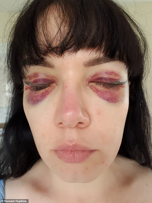 Để tiết kiệm thời gian trang điểm, người phụ nữ ở Anh quyết định đi xăm mí nhưng nhận về kết quả khiến ai cũng giật mình - Ảnh 2.