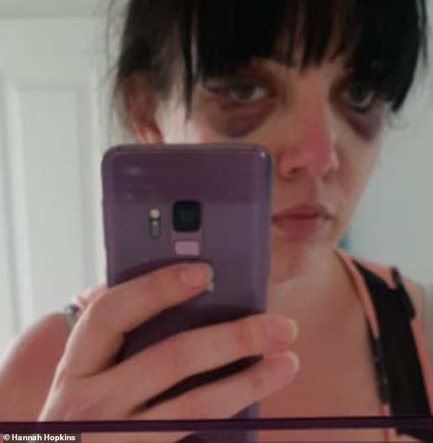 Để tiết kiệm thời gian trang điểm, người phụ nữ ở Anh quyết định đi xăm mí nhưng nhận về kết quả khiến ai cũng giật mình - Ảnh 4.