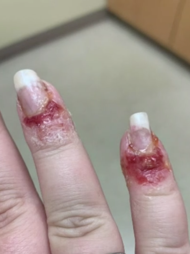 Sơn móng tay bằng bột nhúng nails, cô gái bị chảy máu, mưng mủ kinh hoàng - Ảnh 1.