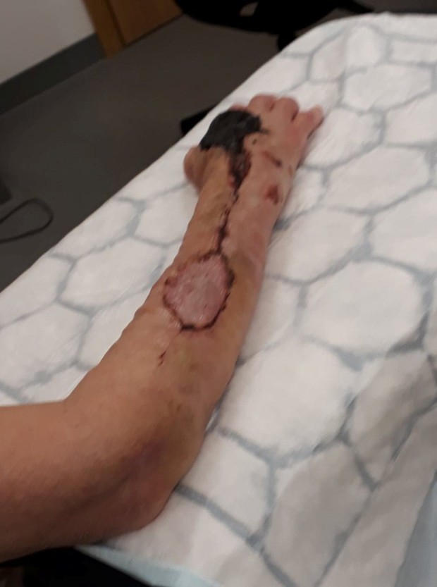 Tưởng vết mèo cào không có gì đáng ngại, người phụ nữ phải nhập viện để cắt bỏ phần da tay bị nhiễm trùng nặng - Ảnh 2.