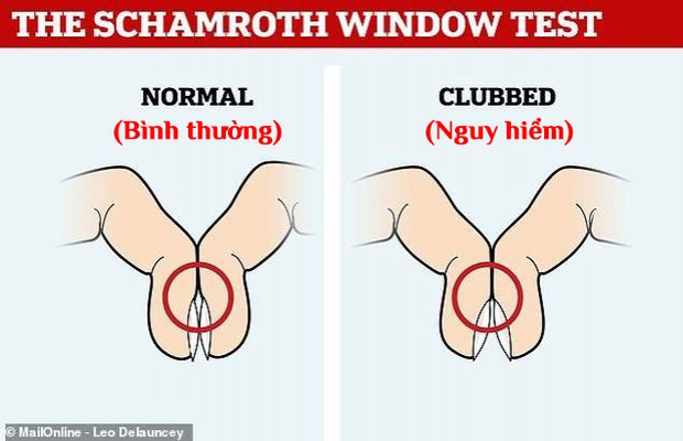 Chỉ một hành động nhỏ khi áp 2 đầu ngón tay vào nhau, bạn có thể nhận biết mình có nguy cơ mắc bệnh ung thư phổi hay không - Ảnh 2.