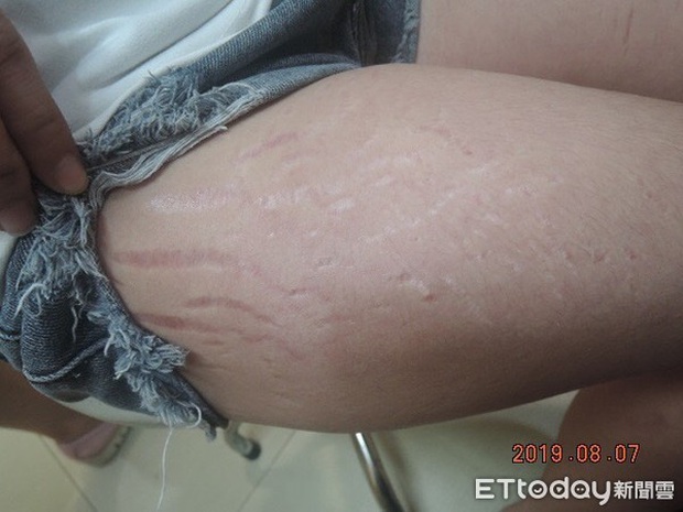 Nghiện bôi kem làm trắng da, 2 chị em người Đài tá hỏa khi thấy làn da rạn nứt, nổi mẩn đỏ quanh cổ - Ảnh 3.